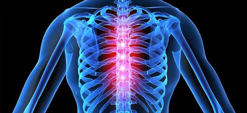 Durerea acută este caracteristică exacerbarii osteocondrozei coloanei vertebrale toracice