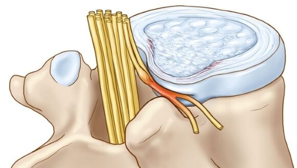 Proeminențele discului intervertebral care apar cu osteocondroza toracică comprimă terminațiile nervoase