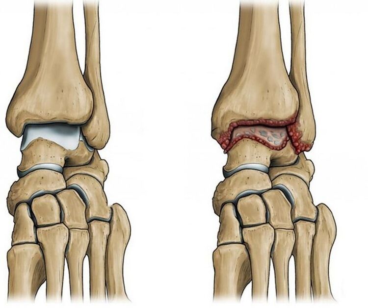 osteoartrita articulației gleznei