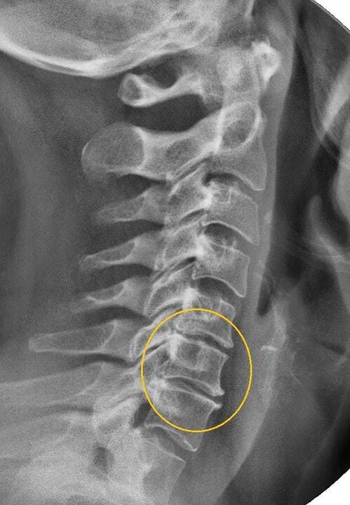osteochondroză