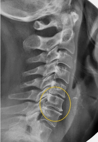 Osteochondroza coloanei vertebrale cervicale pe o rază X