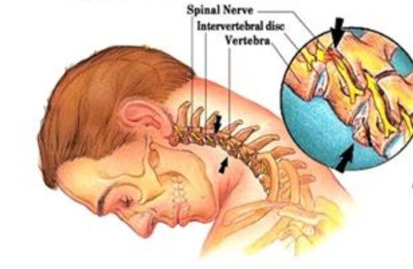 Osteochondroza cervicală