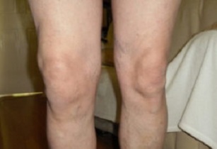 manifestări de artroză a articulației genunchiului (1)