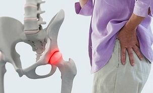 cauzele artrozei articulației șoldului