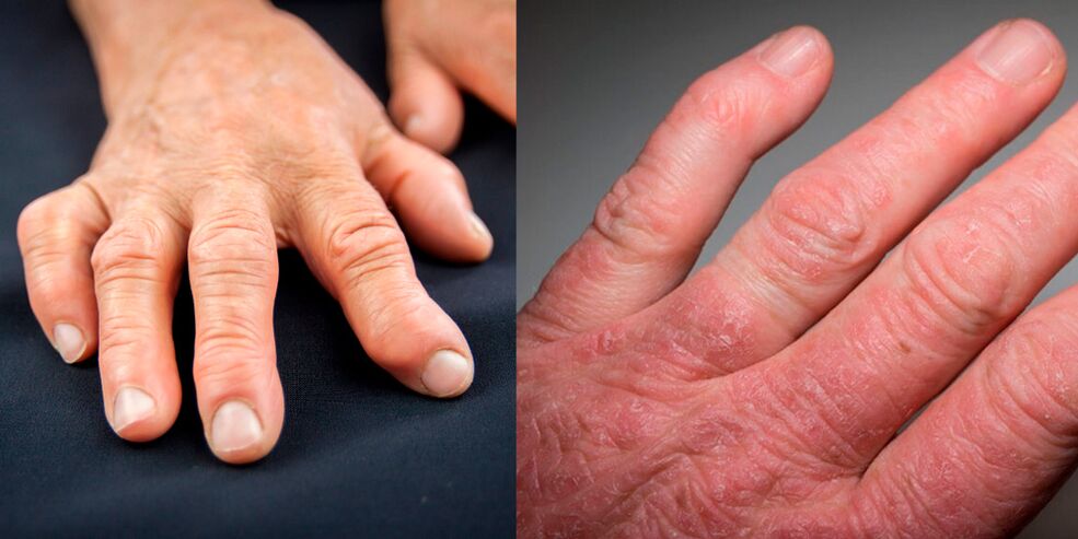 artrita reumatoidă și psoriazică a mâinilor