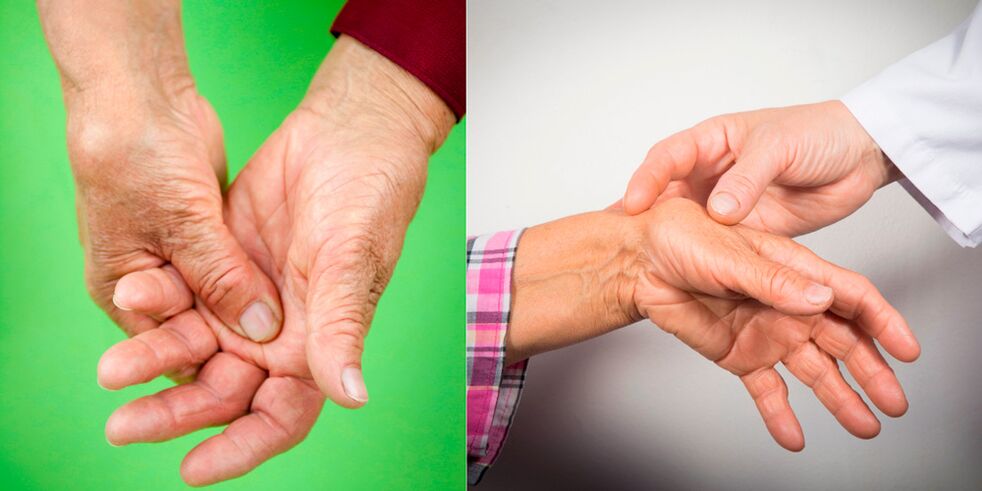 umflarea și durerile dureroase sunt primele semne ale artritei de mână