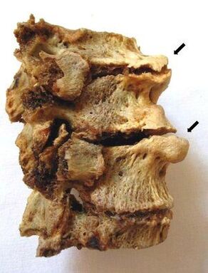 Secțiunea vertebrală afectată de osteocondroză