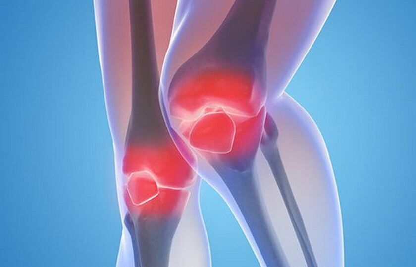 artroza articulațiilor genunchiului