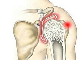 distrugerea articulației umărului cu artroză