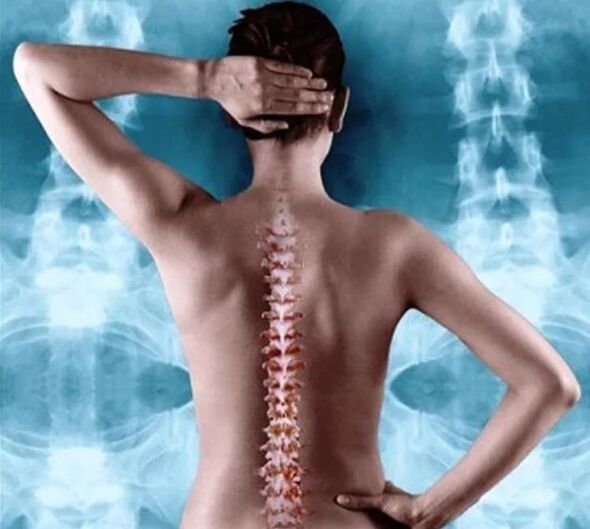 osteocondroza coloanei vertebrale și toracice