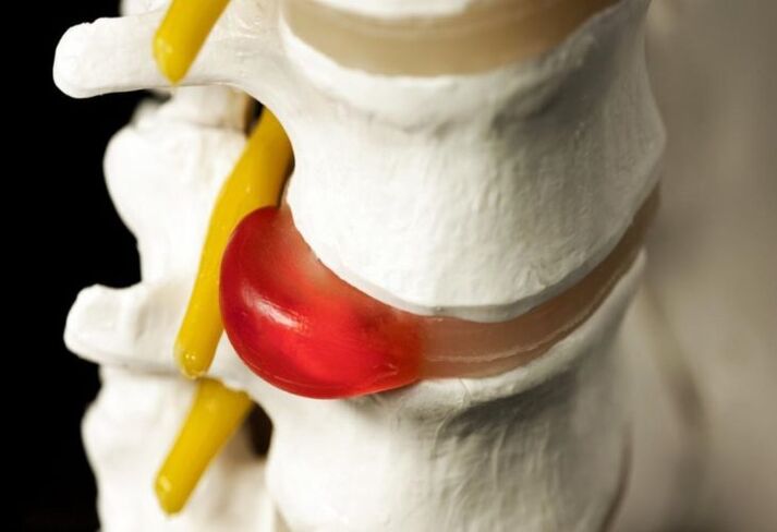 hernia coloanei vertebrale ca o cauză a durerii la omoplați