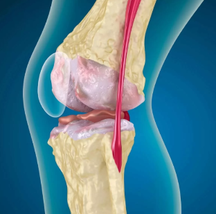 Osteoartrita a genunchiului
