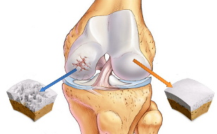 osteoartrita a genunchiului